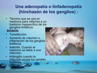 Una adenopatía o linfadenopatía
(hinchazón de los ganglios) :
• Término que se usa en
medicina para referirse a un
trastorno inespecífico de los
ganglios linfáticos.
SIGNOS:
• Tumefacción.
• Aumento de volumen o
inflamación de los ganglios
linfáticos.
• Adenitis. Cuando el
trastorno se debe a una
infección.
• linfangitis cuando la
infección ocupa los canales
linfáticos.
 