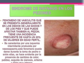 1. problemas de la mama que afectan la lactancia 