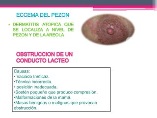 Causas: 
• Vaciado Ineficaz. 
•Técnica incorrecta. 
• posición inadecuada. 
•Sostén pequeño que produce compresión. 
•Malformaciones de la mama. 
•Masas benignas o malignas que provocan 
obstrucción. 
