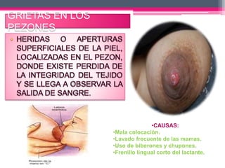 GRIETAS EN LOS 
PEZONES 
•CAUSAS: 
•Mala colocación. 
•Lavado frecuente de las mamas. 
•Uso de biberones y chupones. 
•Frenillo lingual corto del lactante. 
 