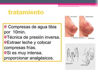 Compresas de agua tibia 
por 10min. 
Técnica de presión inversa. 
Extraer leche y colocar 
compresas frías. 
Si es muy intensa, 
proporcionar analgésicos. 
 