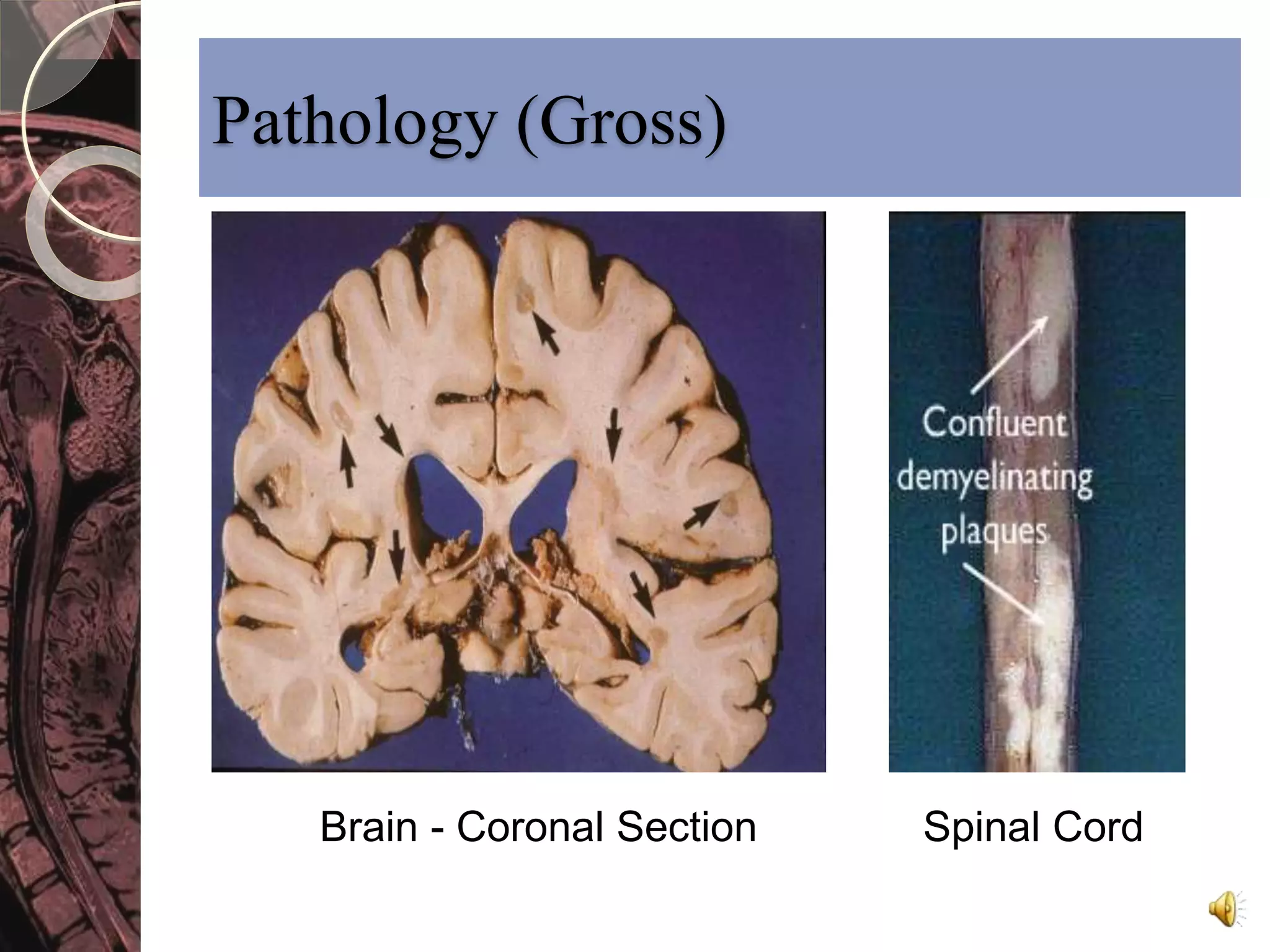Pathology (Gross) 
Brain - Coronal Section Spinal Cord 
 