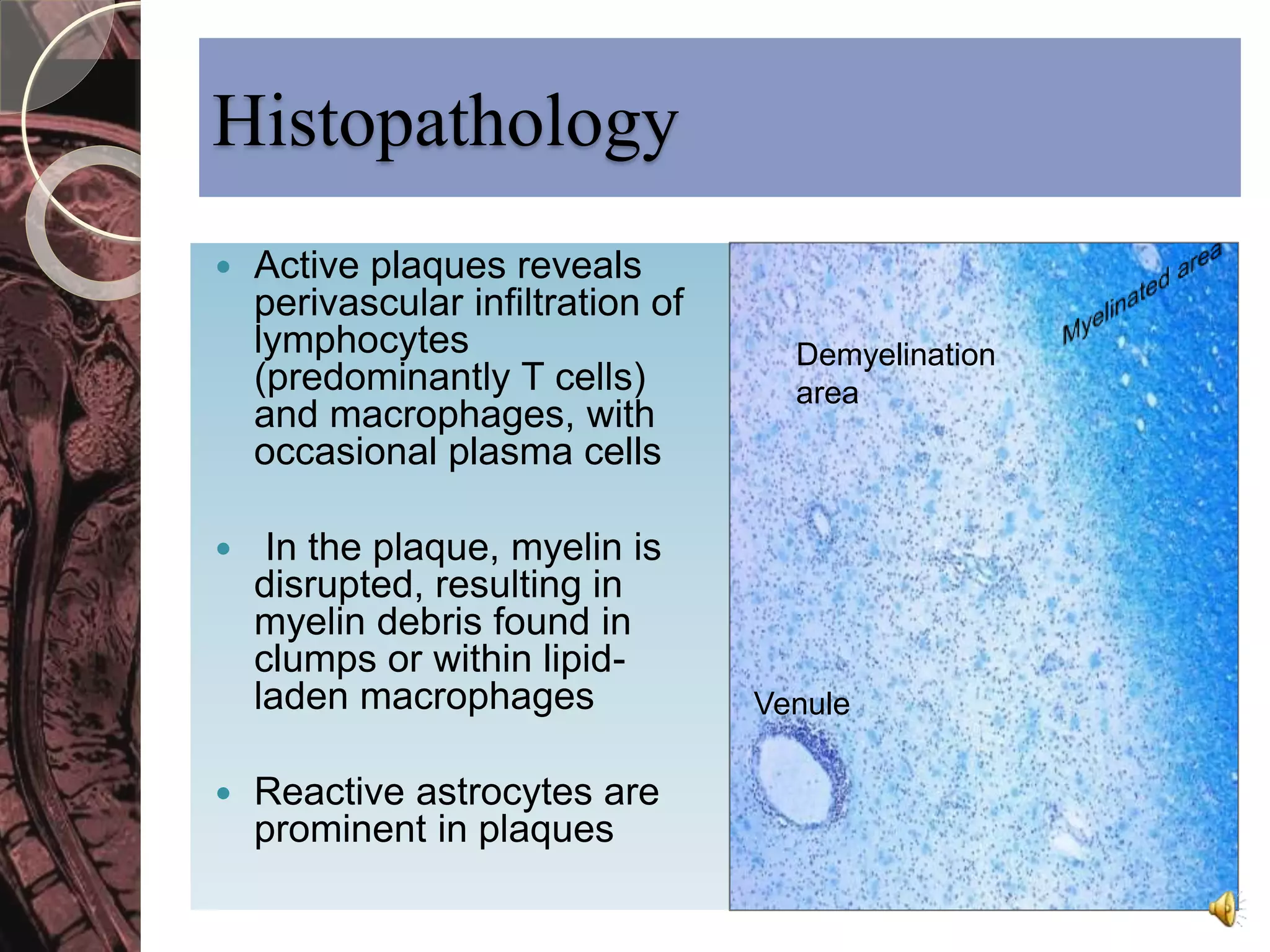 Histopathology 
 Active plaques reveals 
perivascular infiltration of 
lymphocytes 
(predominantly T cells) 
and macrophages, with 
occasional plasma cells 
 In the plaque, myelin is 
disrupted, resulting in 
myelin debris found in 
clumps or within lipid-laden 
macrophages 
 Reactive astrocytes are 
prominent in plaques 
Demyelination 
area 
Venule 
 