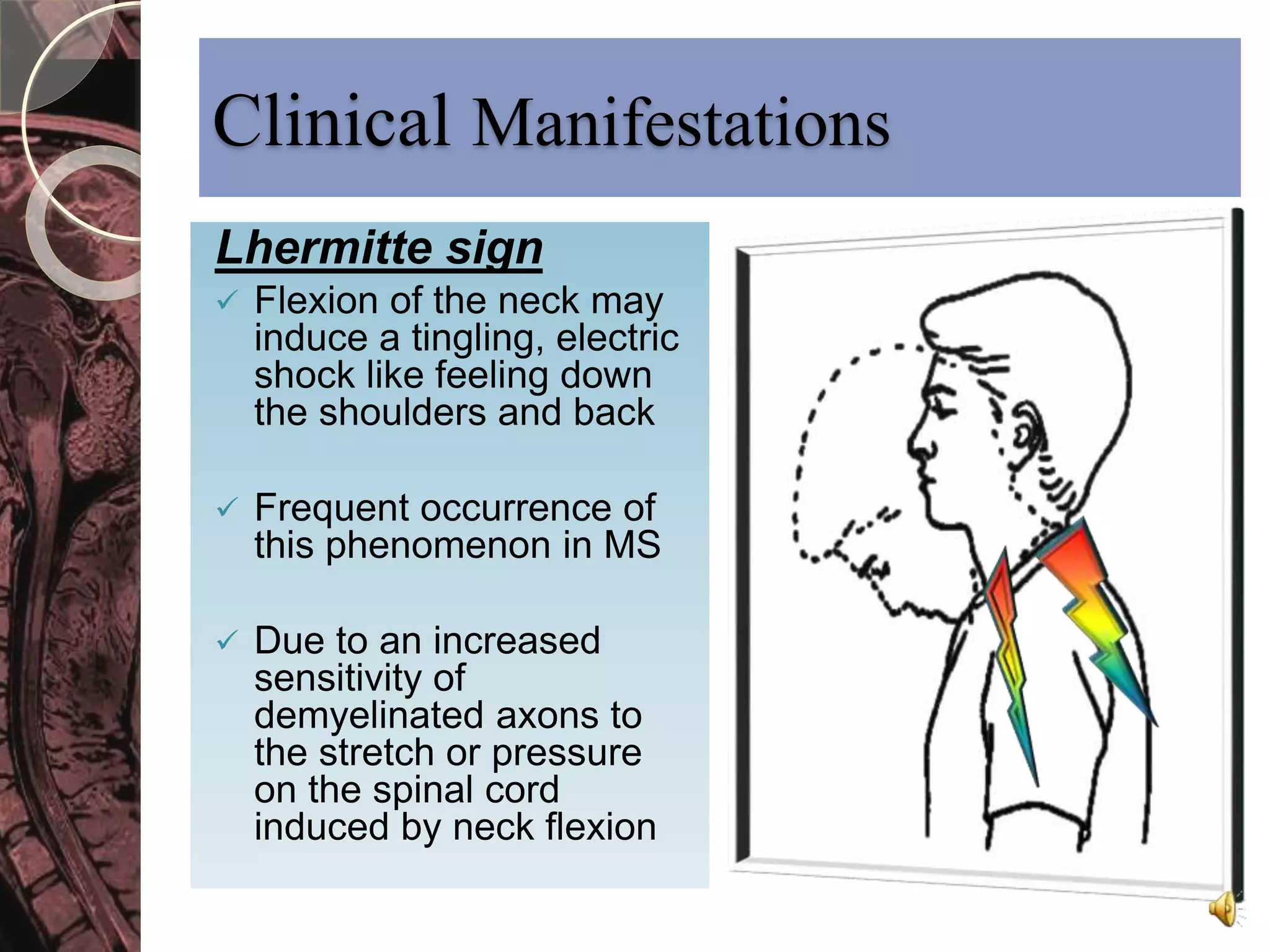 Clinical Manifestations 
Lhermitte sign 
 Flexion of the neck may 
induce a tingling, electric 
shock like feeling down 
the shoulders and back 
 Frequent occurrence of 
this phenomenon in MS 
 Due to an increased 
sensitivity of 
demyelinated axons to 
the stretch or pressure 
on the spinal cord 
induced by neck flexion 
 