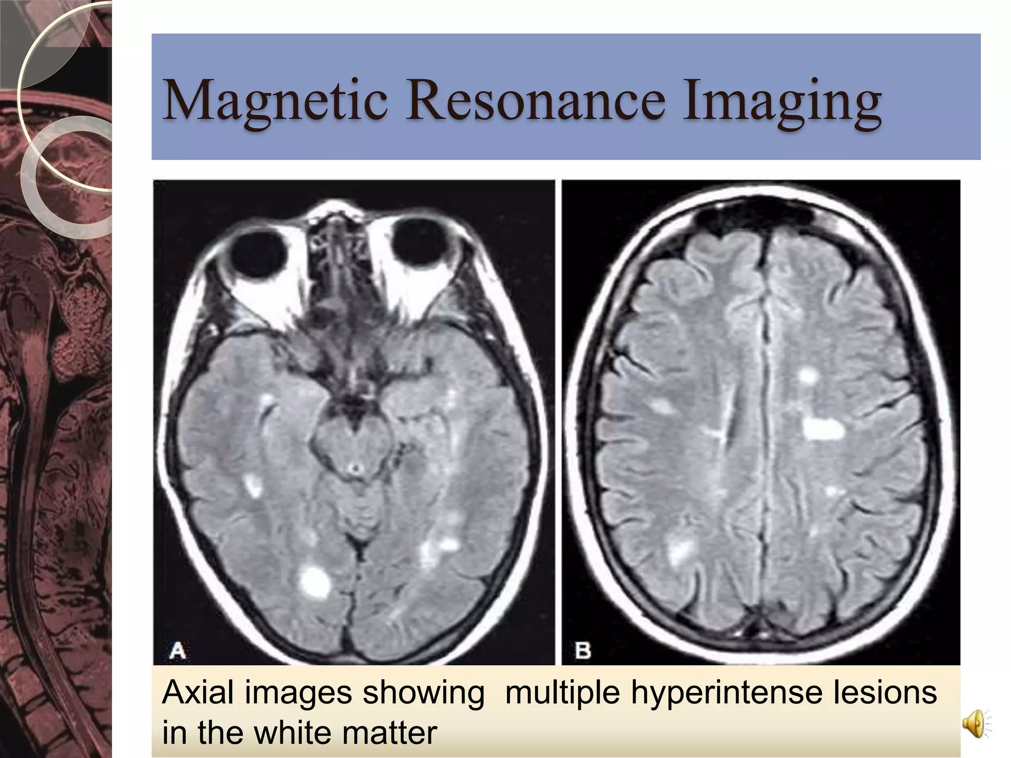 Magnetic Resonance Imaging 
Axial images showing multiple hyperintense lesions 
in the white matter 
 