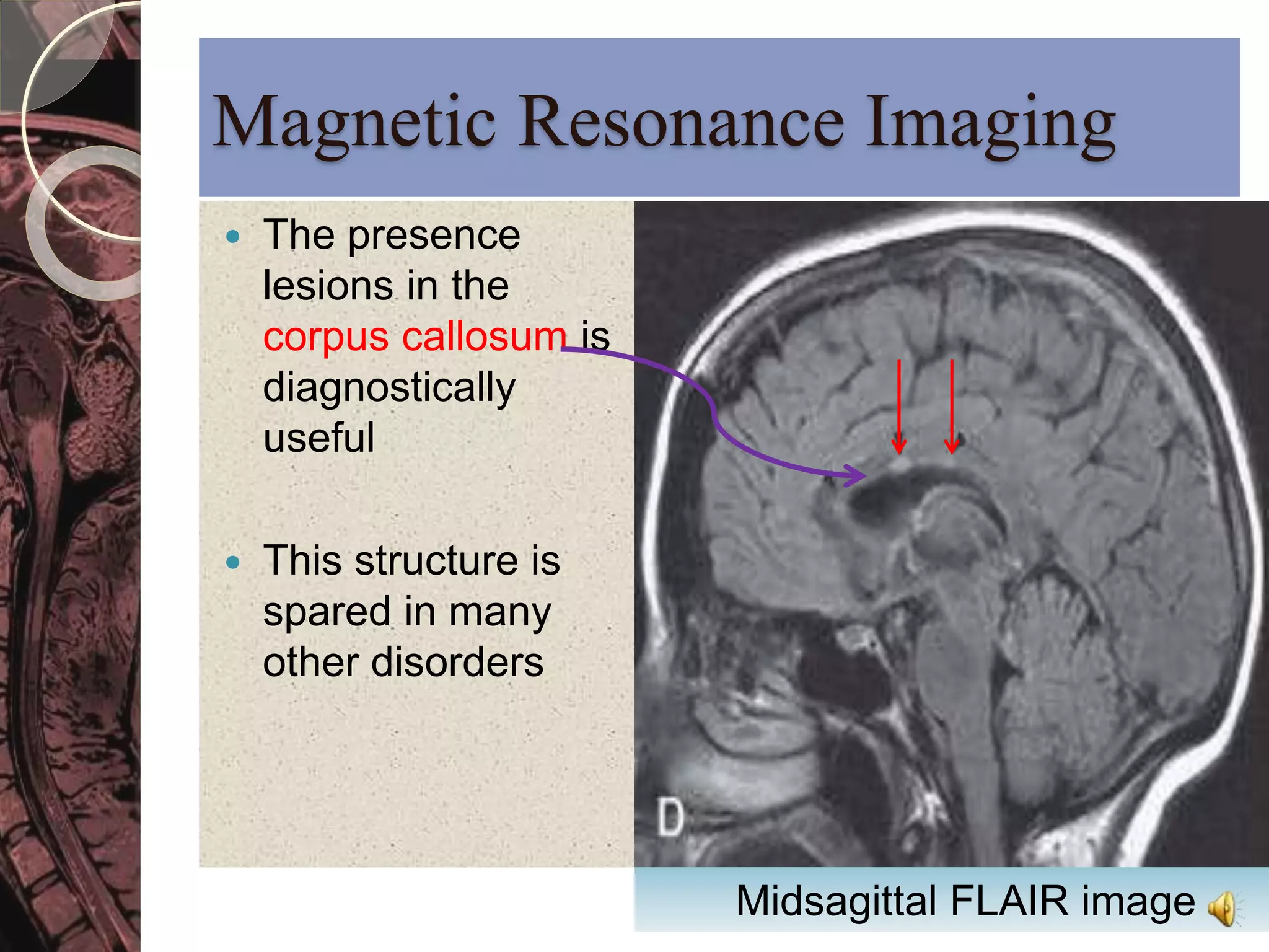 Magnetic Resonance Imaging 
 The presence 
lesions in the 
corpus callosum is 
diagnostically 
useful 
 This structure is 
spared in many 
other disorders 
Midsagittal FLAIR image 
 
