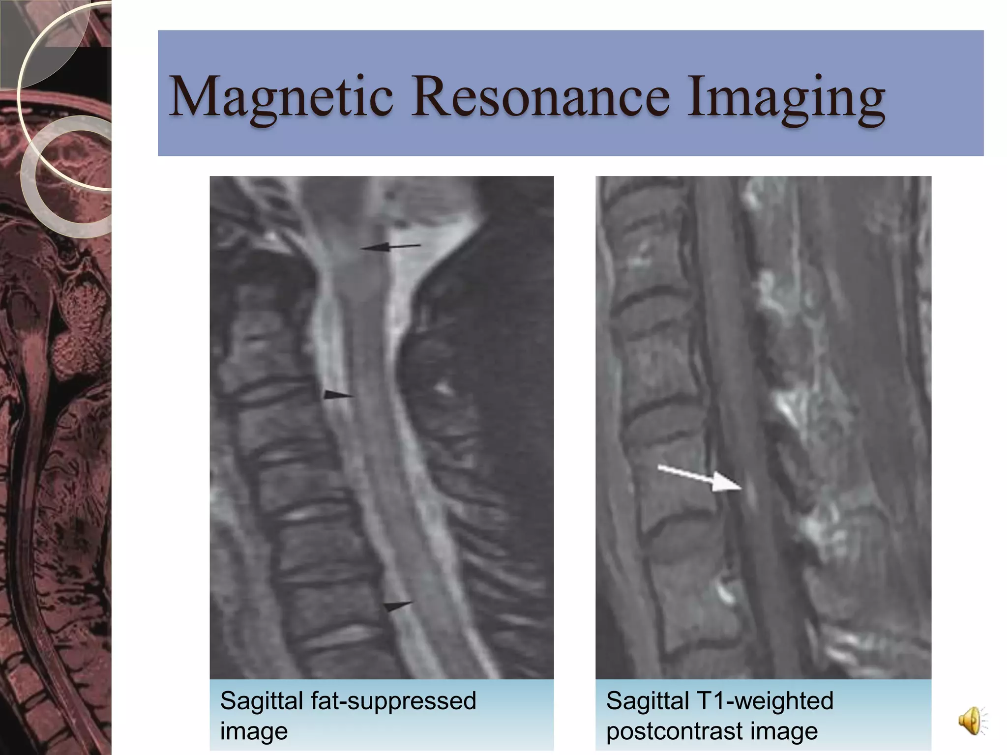 Magnetic Resonance Imaging 
Sagittal fat-suppressed 
image 
Sagittal T1-weighted 
postcontrast image 
 