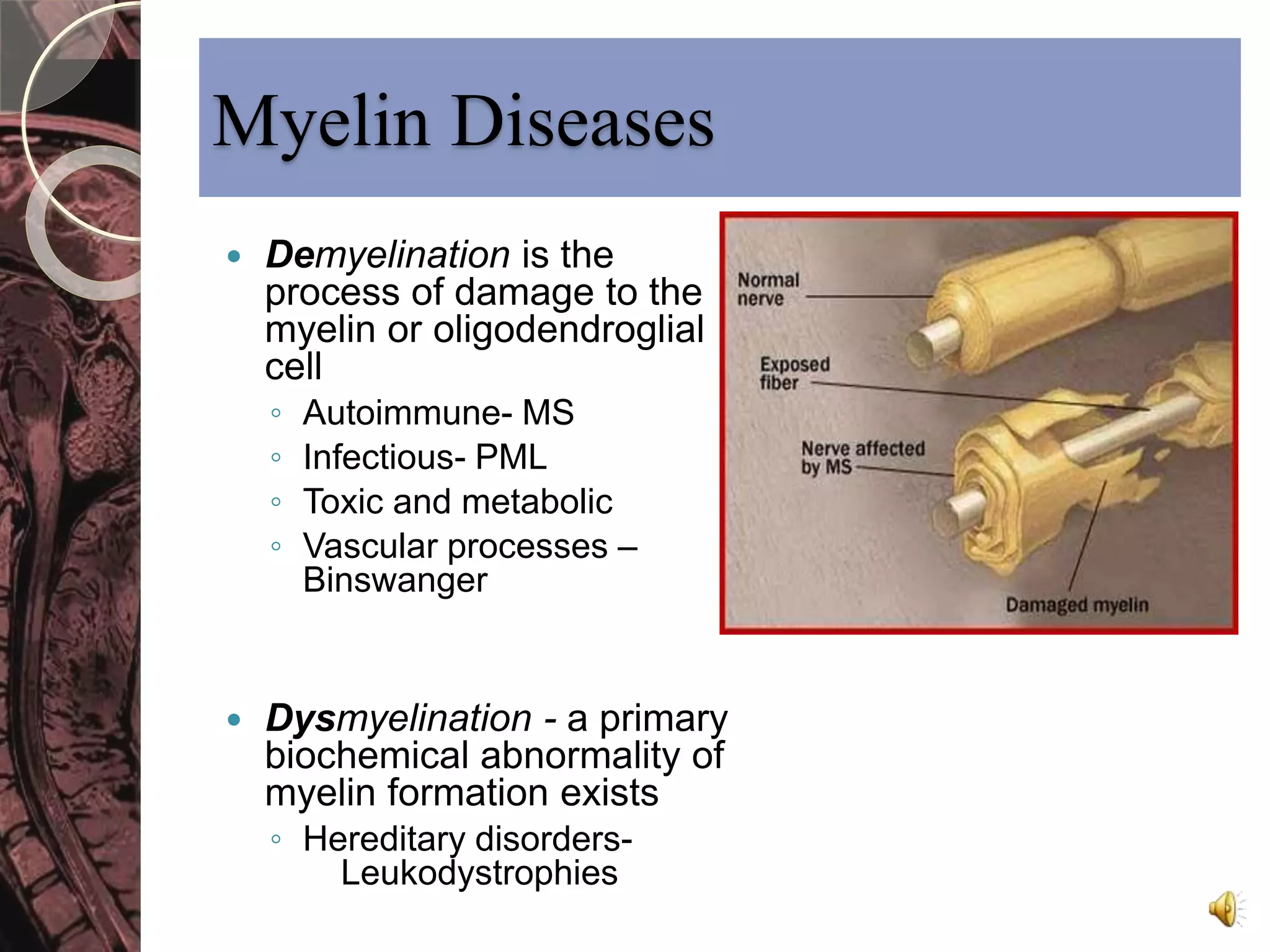 Myelin Diseases 
 Demyelination is the 
process of damage to the 
myelin or oligodendroglial 
cell 
◦ Autoimmune- MS 
◦ Infectious- PML 
◦ Toxic and metabolic 
◦ Vascular processes – 
Binswanger 
 Dysmyelination - a primary 
biochemical abnormality of 
myelin formation exists 
◦ Hereditary disorders- 
Leukodystrophies 
 