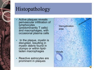 Histopathology 
 Active plaques reveals 
perivascular infiltration of 
lymphocytes 
(predominantly T cells) 
and macrophages, with 
occasional plasma cells 
 In the plaque, myelin is 
disrupted, resulting in 
myelin debris found in 
clumps or within lipid-laden 
macrophages 
 Reactive astrocytes are 
prominent in plaques 
Demyelination 
area 
Venule 
 