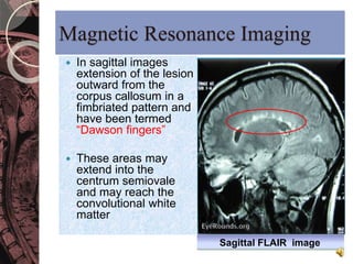 Magnetic Resonance Imaging 
 In sagittal images 
extension of the lesion 
outward from the 
corpus callosum in a 
fimbriated pattern and 
have been termed 
“Dawson fingers” 
 These areas may 
extend into the 
centrum semiovale 
and may reach the 
convolutional white 
matter 
Sagittal FLAIR image 
 