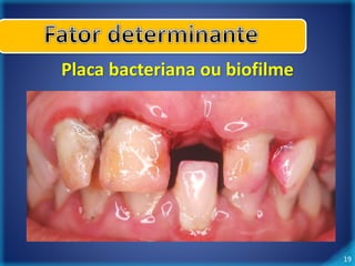 19 
Placa bacteriana ou biofilme 
 