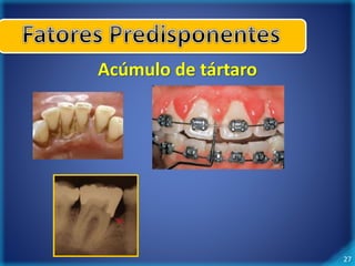 27 
Acúmulo de tártaro 
 