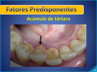28 
Acúmulo de tártaro 
 