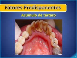 30 
Acúmulo de tártaro 
 