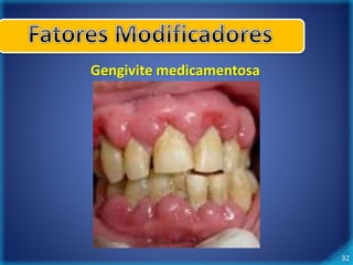 32 
Gengivite medicamentosa 
 