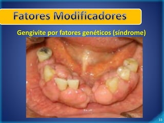 33 
Gengivite por fatores genéticos (síndrome) 
 