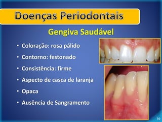 39 
Gengiva Saudável 
• Coloração: rosa pálido 
• Contorno: festonado 
• Consistência: firme 
• Aspecto de casca de laranja 
• Opaca 
• Ausência de Sangramento 
 
