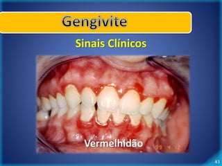 43 
Sinais Clínicos 
Vermelhidão 
 