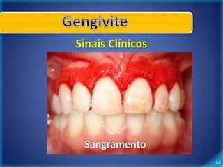 44 
Sinais Clínicos 
Sangramento 
 