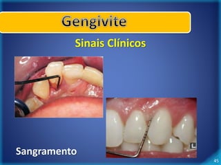 45 
Sinais Clínicos 
Sangramento 
 