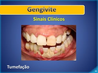 46 
Sinais Clínicos 
Tumefação 
 