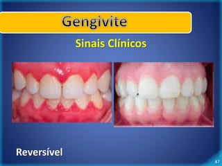47 
Sinais Clínicos 
Reversível 
 