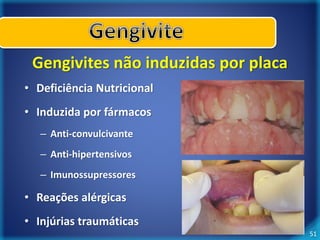 51 
Gengivites não induzidas por placa 
• Deficiência Nutricional 
• Induzida por fármacos 
– Anti-convulcivante 
– Anti-hipertensivos 
– Imunossupressores 
• Reações alérgicas 
• Injúrias traumáticas 
 