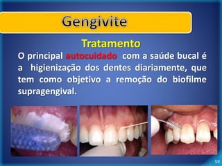 59 
Tratamento 
O principal autocuidado com a saúde bucal é 
a higienização dos dentes diariamente, que 
tem como objetivo a remoção do biofilme 
supragengival. 
 