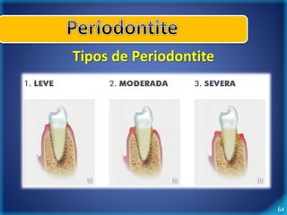 64 
Tipos de Periodontite 
 