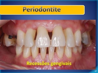 67 
Recessões gengivais 
 