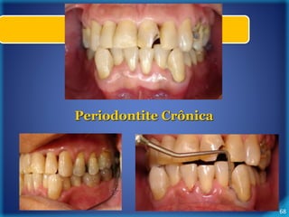 68 
Periodontite Crônica 
 