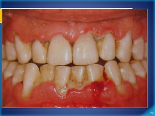 70 
Periodontite Crônica 
 