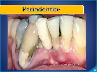 71 
Periodontite Crônica 
 