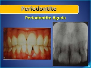 78 
Periodontite Aguda 
Rápida destruição óssea 
 