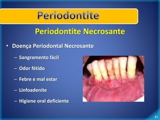81 
Periodontite Necrosante 
• Doença Periodontal Necrosante 
– Sangramento fácil 
– Odor fétido 
– Febre e mal estar 
– Linfoadenite 
– Higiene oral deficiente 
 