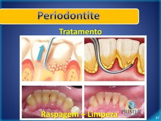 87 
Tratamento 
Raspagem + Limpeza 
 