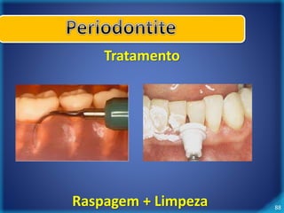 88 
Tratamento 
Raspagem + Limpeza 
 