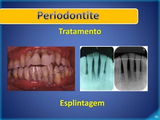 90 
Tratamento 
Esplintagem 
 