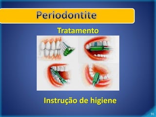 91 
Tratamento 
Instrução de higiene 
 