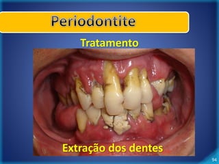 94 
Tratamento 
Extração dos dentes 
 
