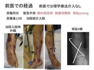 下腿コンパートメント症候群後の足部変形に装具療法が著効した1例 | PPTX