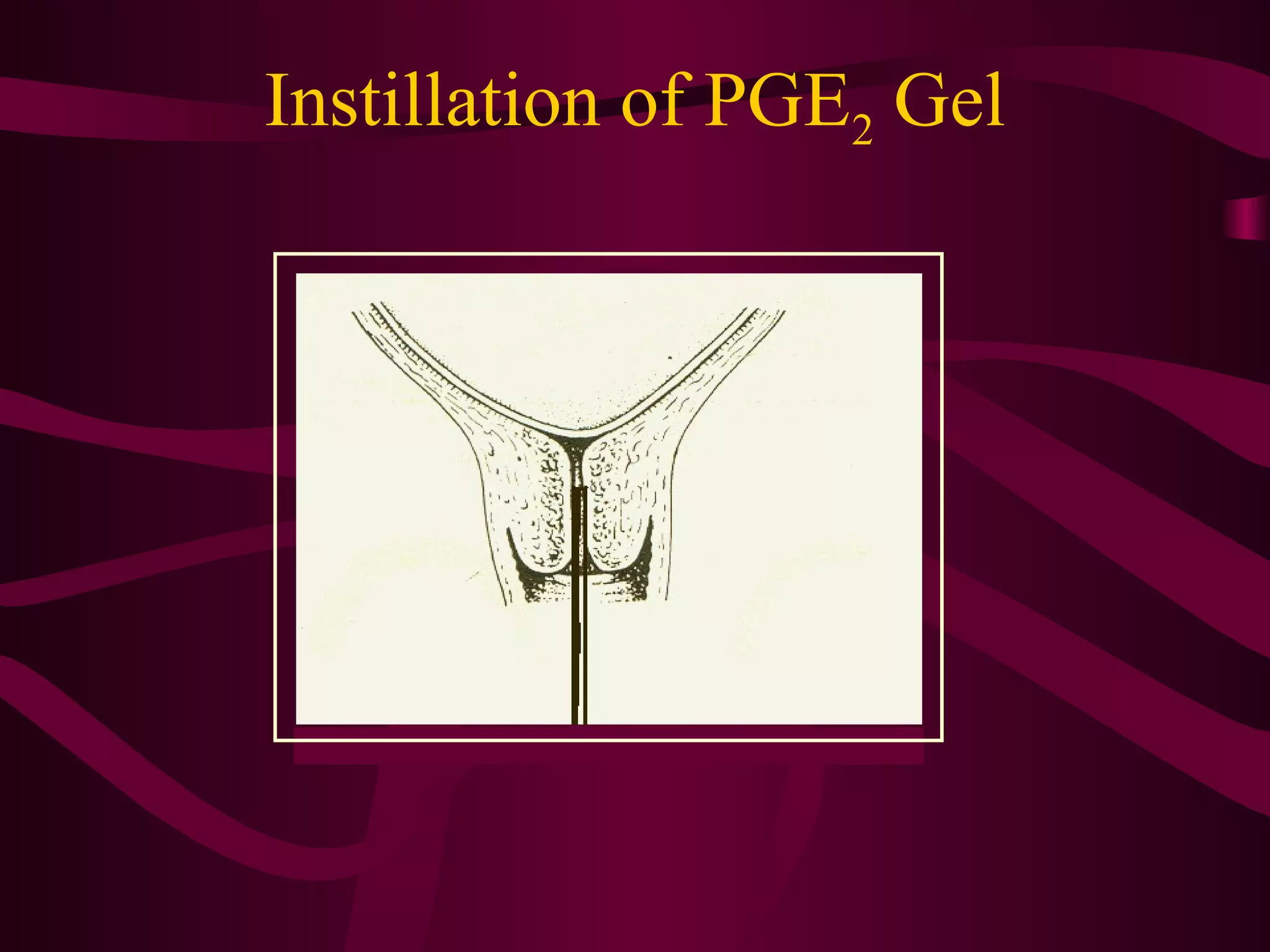 Instillation of PGE2 Gel
 