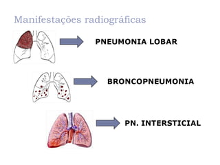 Manifestações radiográficas
 