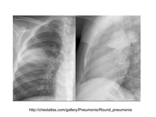 http://chestatlas.com/gallery/Pneumonia/Round_pneumonia
 