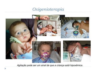 Oxigenioterapia
Agitação pode ser um sinal de que a criança está hipoxêmica.
 