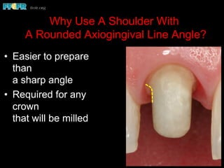 Why Use A Shoulder With
A Rounded Axiogingival Line Angle?
•  Easier to prepare
than
a sharp angle
•  Required for any
crown
that will be milled
 