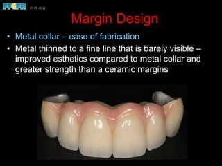 Margin Design
•  Metal collar – ease of fabrication
•  Metal thinned to a fine line that is barely visible –
improved esthetics compared to metal collar and
greater strength than a ceramic margins
 