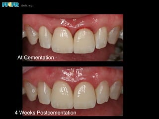 At Cementation
4 Weeks Postcementation
 