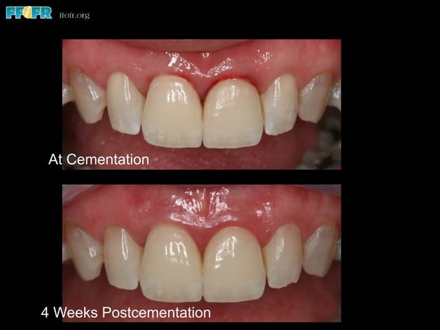 1 anterior Mcc Prep PDF Dental Health Diseases And Conditions 1-anterior-mcc-prep-pdf-dental-health-diseases-and-conditions