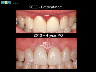 2013 – 4 year PO
2009 - Pretreatment
 